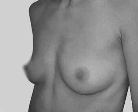 Galerie Implant mamar Dr Ovidiu Grecu (9)