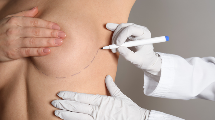 Augmentare mamară cu implanturi anatomice de 290 cc