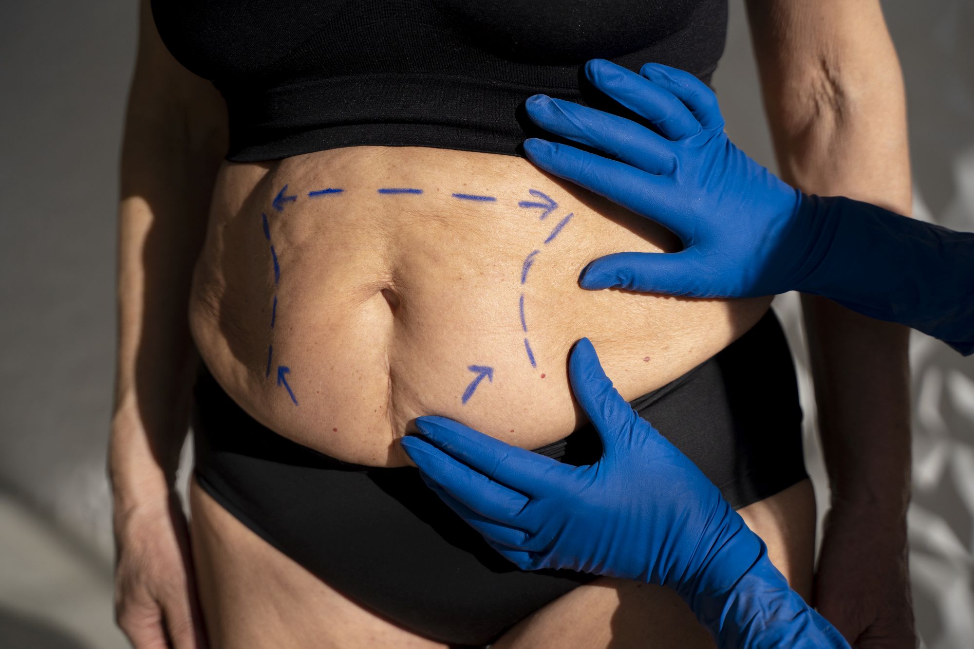 Abdominoplastia, operația care îți oferă un abdomen plat