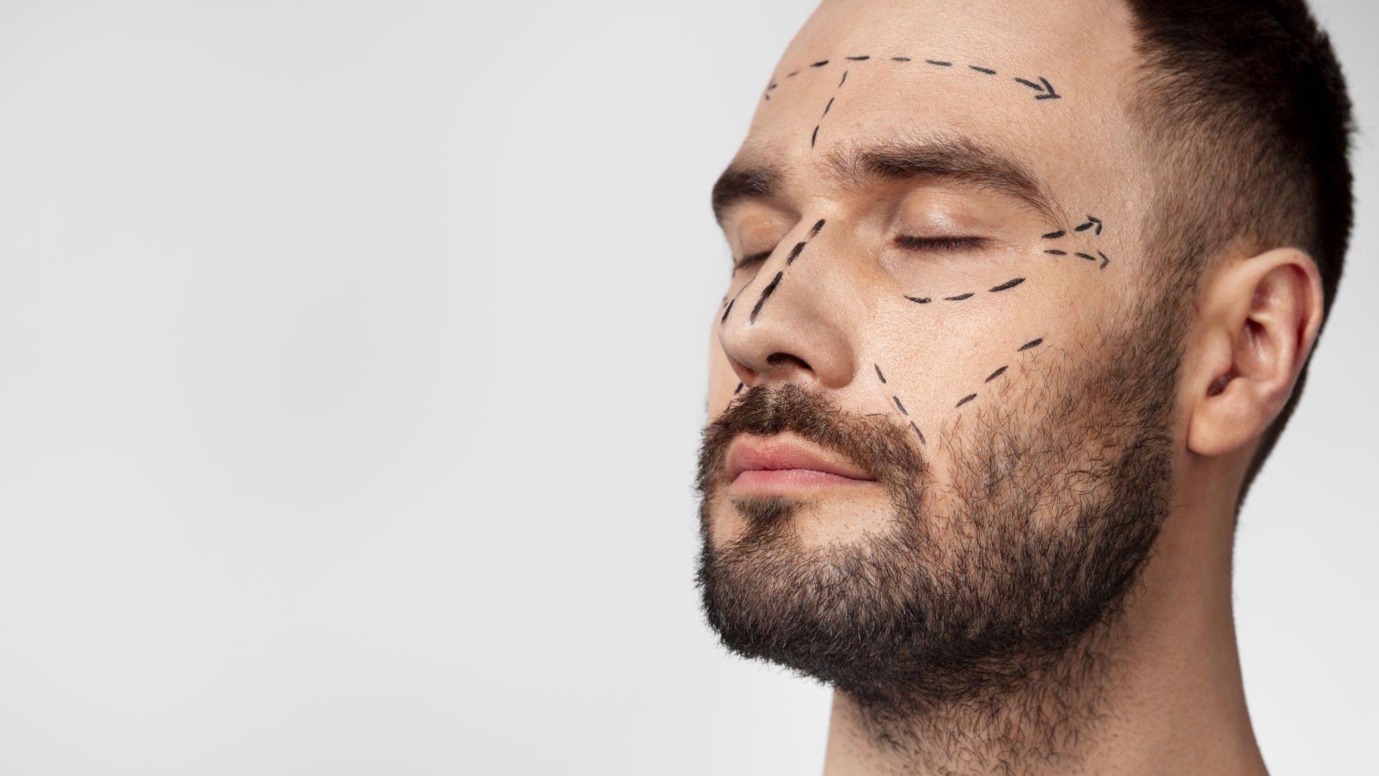 Rinoplastie: la ce sa te astepti inainte si dupa operatie