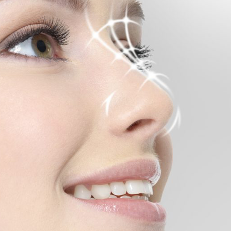 Remodelarea nasului fara operatie – rinocorectie cu acid hialuronic